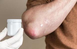 Ein Dermatologe in Handschuhen trägt eine therapeutische Salbe auf die betroffene Haut eines Patienten mit Psoriasis auf foto