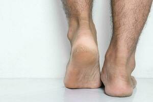 Männer ein Füße Haut geknackt Absätze foto