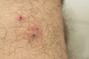 Mücken beißt Das erscheinen zu Sein leicht infiziert von Kratzen foto