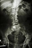 Skoliose-Film Röntgen Lendenwirbelsäule zeigen Wirbelsäulenbeugung bei alten Patienten foto