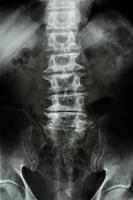 Spondylose Film Röntgen ls Wirbelsäule lumbales Kreuzbein eines alten Patienten foto