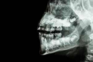 Film Röntgen Mensch Kiefer und Zähne und leerer Bereich auf der linken Seite foto