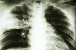 Film Röntgenaufnahme zeigen fleckiges Infiltrat an der rechten mittleren Lungenlappenpneumonie aufgrund einer Mycobacterium tuberculosis-Infektion Lungentuberkulose foto