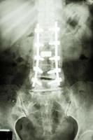 Filmröntgen zeigen Lendenwirbelsäule mit Pedikelschraubenfixation bei Spondylolithese-Patienten foto