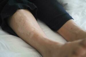 Füße mit Vitiligo Haut Zustand. foto