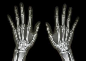 Filmröntgen beide Hände ap Vorderansicht zeigen normale menschliche Hände auf schwarzem Hintergrund isoliert foto