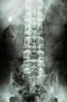 Filmröntgen kub Nieren-Harnleiter-Blase zeigen rechten Nierenstein runde Form auf der rechten Seite foto