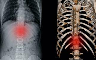 Röntgen und ct Scan Brust Rücken Fraktur. foto
