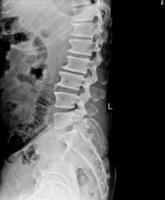 Lendenwirbelsäule Rücken Röntgen Show Sporn von Wirbelkörper Körper. foto