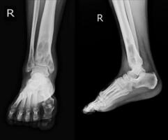 Röntgen rt.knöchel finden intramedullär osterolytisch Läsion von richtig distal Tibia foto