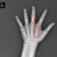 Röntgen beide Hände auf Weiß Hintergrund medizinisch Bild Konzept. foto