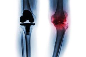 Filmröntgenbild eines Kniepatienten mit Osteoarthritis und eines künstlichen Gelenk-Total-Knieersatzes. isolierter Hintergrund. foto