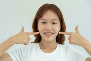Behandlung. Dental Pflege. schön asiatisch Frau gesund smile.metal Klammern auf Zähne. jung weiblich Lächeln mit Hosenträger und Show schön von Zähne, Pflege nach Zahnspange, zuversichtlich im Kieferorthopädie foto