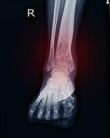 Röntgen rt.knöchel finden intramedullär osterolytisch Läsion von richtig distal Tibia foto