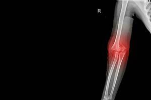 Röntgen Ellbogen Joint finden suprakondylär Fraktur distal Humerus mit Joint Erguss.medizinisch Bild Konzept. foto