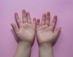 Dermatitis , Kinder- Finger, Haut Infektion, stark Infektion foto