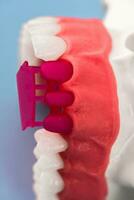 Zähne implantieren und Krone Installation Prozess Teile isoliert auf ein Blau Hintergrund. medizinisch genau 3d Modell. foto