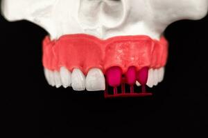 Zähne implantieren und Krone Installation Prozess Teile isoliert auf ein Blau Hintergrund. medizinisch genau 3d Modell. foto