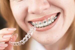 Dental Sorge.lächelnd Mädchen mit Hosenträger auf ihr Zähne hält Aligner im ihr Hände und zeigt an das Unterschied zwischen Sie foto