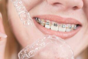 Dental Sorge.lächelnd Mädchen mit Hosenträger auf ihr Zähne hält Aligner im ihr Hände und zeigt an das Unterschied zwischen Sie foto