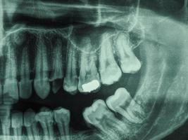 Röntgenaufnahme der menschlichen Zähne foto