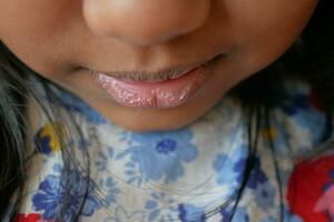 schließen oben von trocken Lippe von ein Kind foto