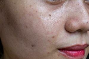 schwarz Flecken, Narben und Akne auf das Gesicht von asiatisch Frau. foto