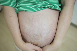Umarmen Mutterschaft asiatisch schwanger Frau mit strecken Markierungen liebevoll hält Bauch foto