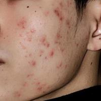 Nahaufnahme von Akne auf der Haut, Akne im Gesicht, die durch Hormone verursacht wird.