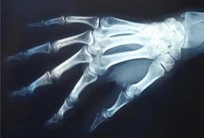 Röntgen der Hand foto