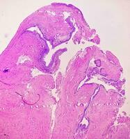 Histologie von Urachal Zyste. Mikrophotographie von histologisch befleckt rutschen zeigen Urachal Zyste. Harnröhre Zyste. foto