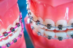 das Hosenträger sind platziert auf das Zähne im das künstlich Kiefer. Makro Fotografie foto