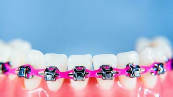 Hosenträger sind platziert auf das Zähne im das künstlich Kiefer gegen ein Licht Blau Hintergrund. Makro Fotografie foto