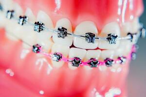 das Hosenträger sind platziert auf das Zähne im das künstlich Kiefer. Makro Fotografie foto