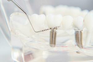 ein Modell- von Zähne mit Implantate Lügen auf ein Tabelle foto