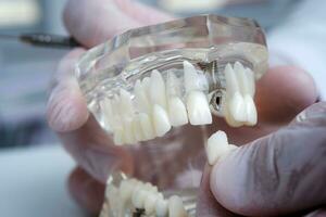 das Kieferorthopäde hält ein Modell- von Zähne mit Implantate im seine Hand und zeigt an Wie zu einfügen das Zahn. schließen hoch. Makro foto