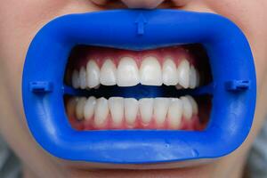 Verfahren zum Vergleichen das Farbe Schatten von Zähne mit Tests nach Bleichen foto