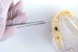 Arzt Kieferorthopäde zeigt an das Instrument auf Karies im das Zähne foto