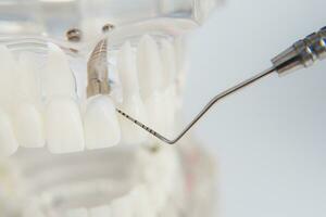 ein Modell- von Zähne mit Implantate Lügen auf ein Tabelle foto