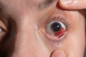 Blutung im das Auge von ein Mädchen. Abrieb von das Hornhaut. Makro. foto