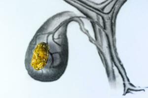 Galle Blase Stein, schematisch Darstellung, groß Größe Gallenstein, Ergebnis von Gallenstein Krankheit. foto