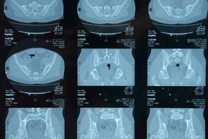 mri Iliosakral Artikulation. Studie von ankylosieren Spondyloarthritis geduldig. foto