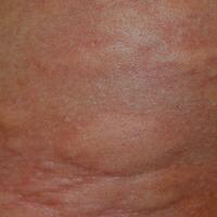 Allergie Haut zurück und Seiten. allergisch Reaktionen auf das Haut im das bilden von Schwellung und Rötung foto