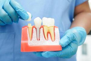 Arzt halt Dental implantieren, künstlich Zahn Wurzeln in Kiefer, Wurzel Kanal von Dental Behandlung, Gummi Krankheit, Zähne Modell- zum Zahnarzt studieren Über Zahnheilkunde. foto