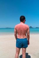 Haut auf der Rückseite des jungen Mannes bekommt Sonnenbrand nach dem Schwimmen im Meer an einem sonnigen Tag im Sommer foto