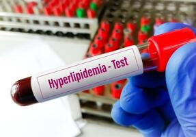 Blut Stichprobe zum Dyslipidämie prüfen. Hyperlipidämie. Lipid Profil foto