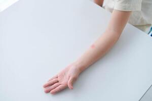 Nahansicht von ein Kinder Hand mit ein rot Stelle Reaktion zu das mantoux Prüfung 72 Std nach Injektion. foto