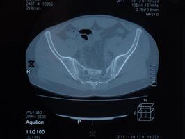 mri Iliosakral Artikulation. Studie von ankylosieren Spondyloarthritis geduldig. foto