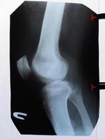 Röntgen von das Knie Gelenke, ein Bild von das Knochen von das Knie auf das Röntgen. foto