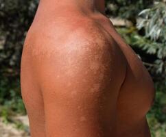 Sonnenbrand auf das Haut von das Schultern. Peeling, Haut schält aus. gefährlich Sonne bräunen foto